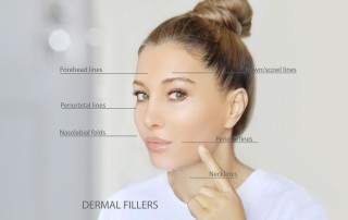 face locations for dermal fillers